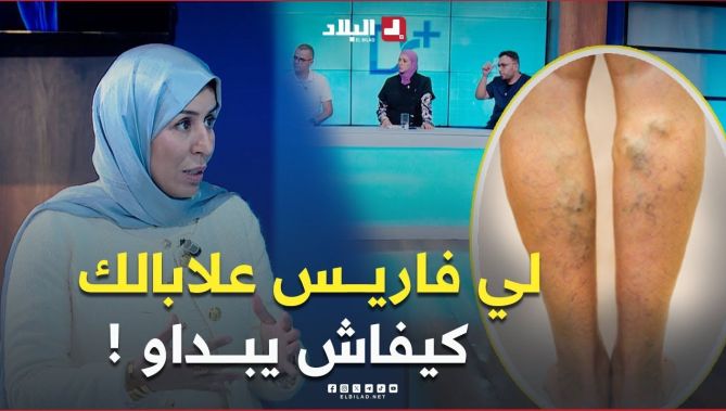 علابالك كيفاش يبانو " #ليفاريــس" وواش يصرى حتى يولــي #مرض؟ شوف الفيديو 👇