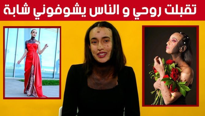 ليزا باتو ... قصة شابة جزائرية مع مرض نادر جعلها تتميز و تتألق في مجال عرض الأزياء