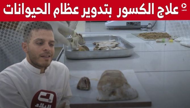 #أيمن_دراجي طالب جامعي من #سطيف يبتكر طريقة لعلاج الكسور بـعظام الحيوانات.. شاهد: