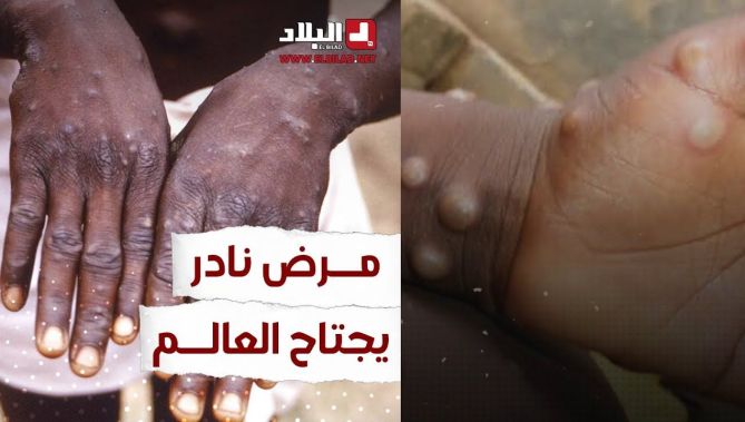 مرض "جدري القرود" يجتاح العالم.. تعرفوا عليه من خلال هذا الفيديو: